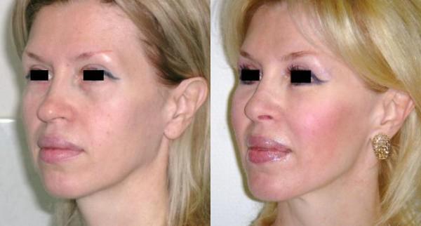 lipofilling visage Tunisie