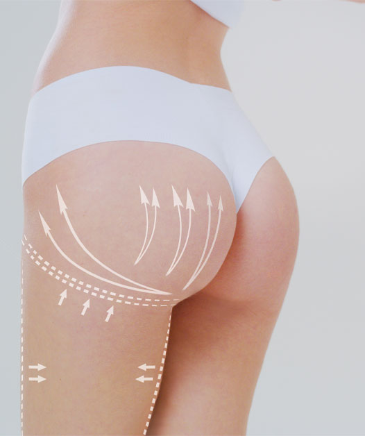 Augmentation fesses