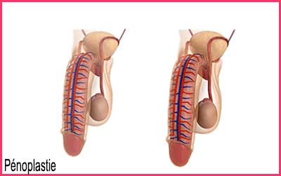 penoplastie Tunisie