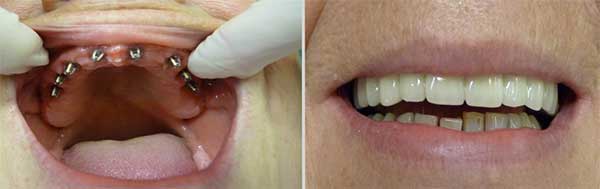 resultat pose implant dentaire tunisie