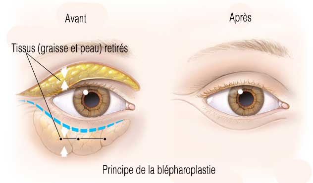 principe blepharoplastie