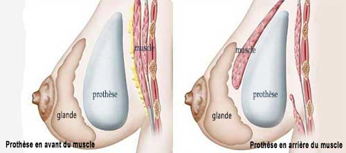 position de pose d'implant mammaire