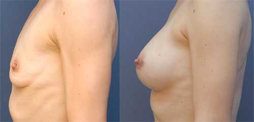 resultat augmentation mammaire protehse