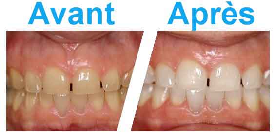 Resultat photos avant apres blanchiment dents Tunisie