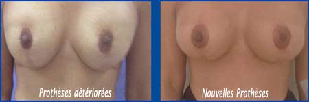 resultat changement protheses mammaires