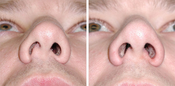 resultat correction deviation cloison nasale