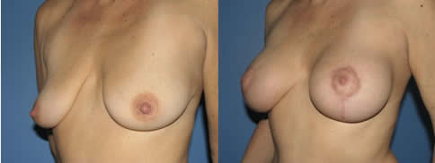 resultat lifting seins mastopexie Tunisie