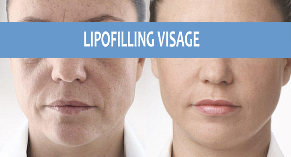 resultat lipofilling visage