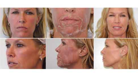 Resultat peeling facial Tunisie