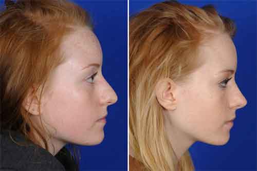 Rhinoplastie Tunisie : Prix chirurgie esthetique nez, rhinoplastie ...