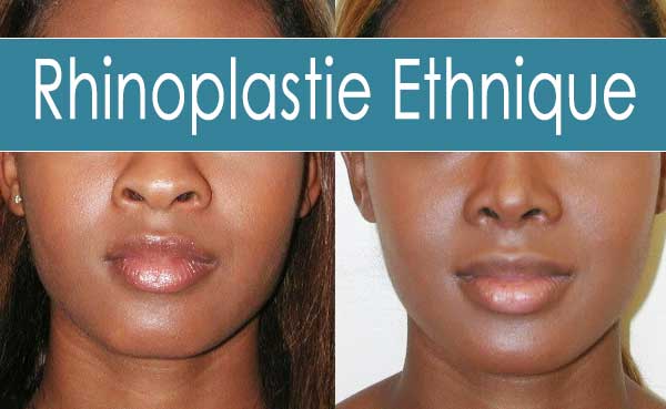 rhinoplastie ethnique Tunisie