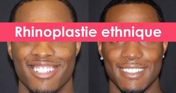 rhinoplastie ethnique tunisie